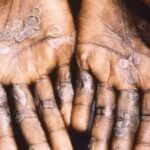 Ahli Pastikan Cacar Monyet Tidak Akan Menjadi Pandemi