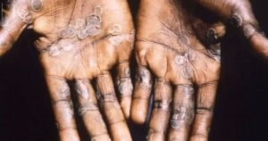 Ahli Pastikan Cacar Monyet Tidak Akan Menjadi Pandemi