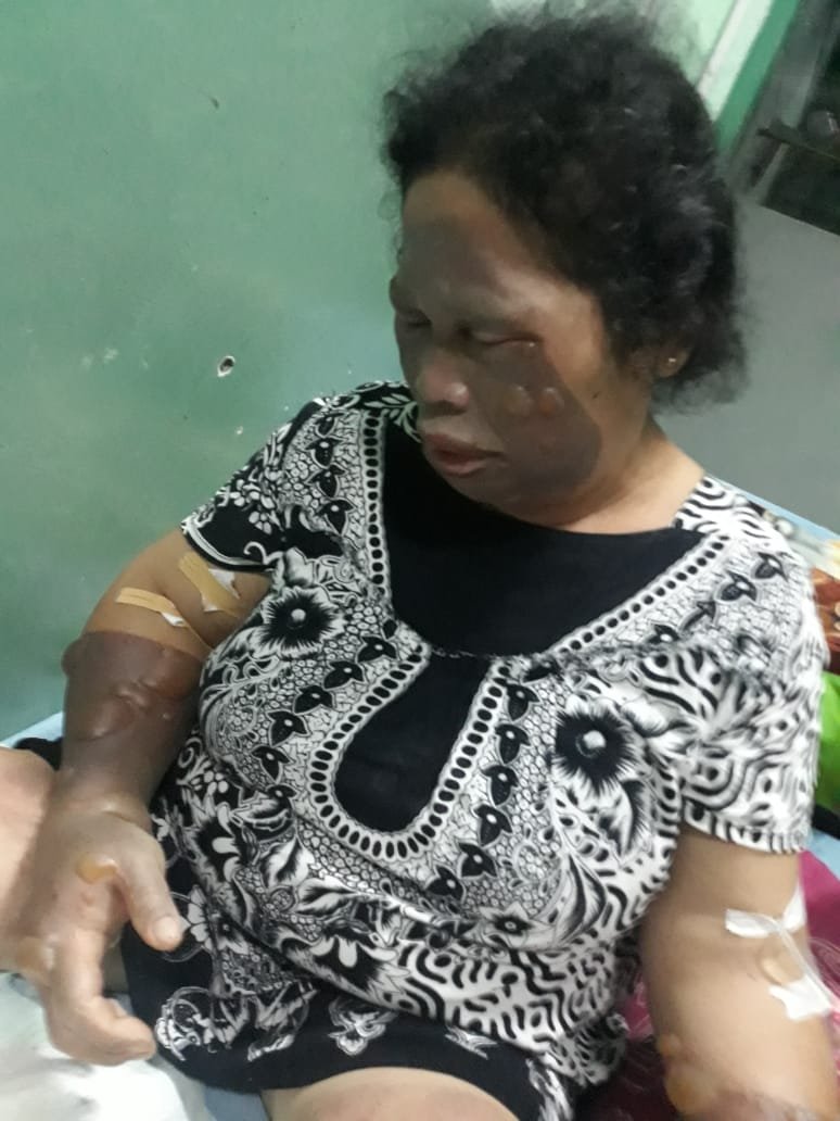 Tabung Elpigi 3 Kg Meledak, Dua Warga Jadi Korban